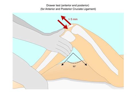 acl and pcl tear test|acl and pcl are intact.